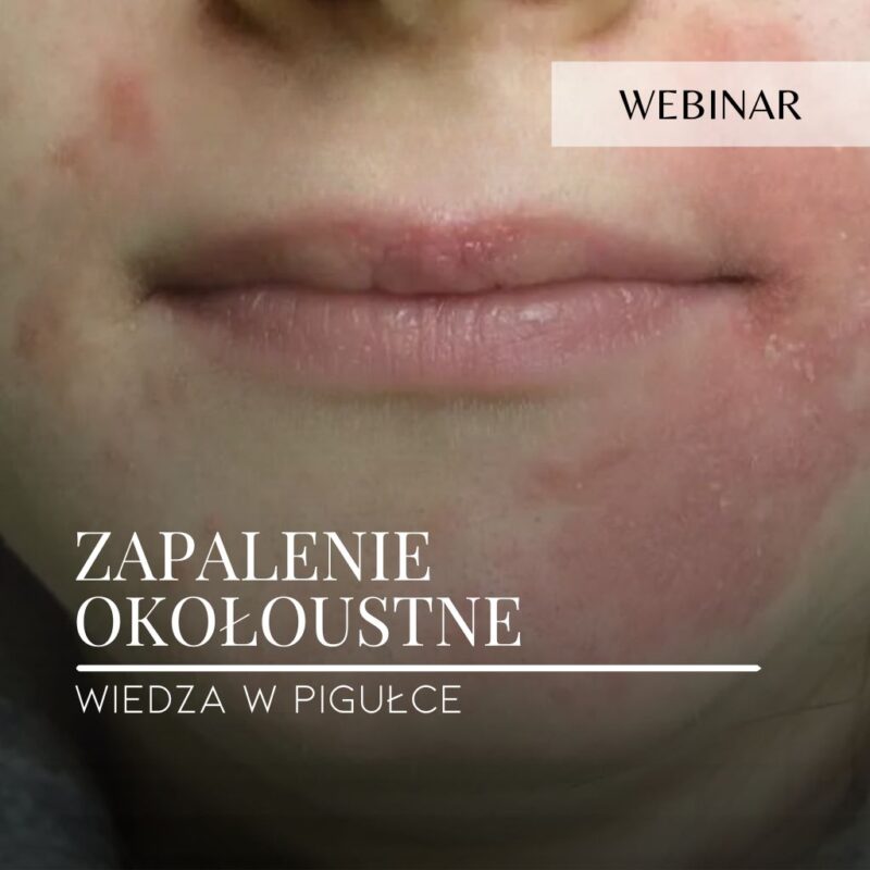 Webinar_Zapalenie okołoustne