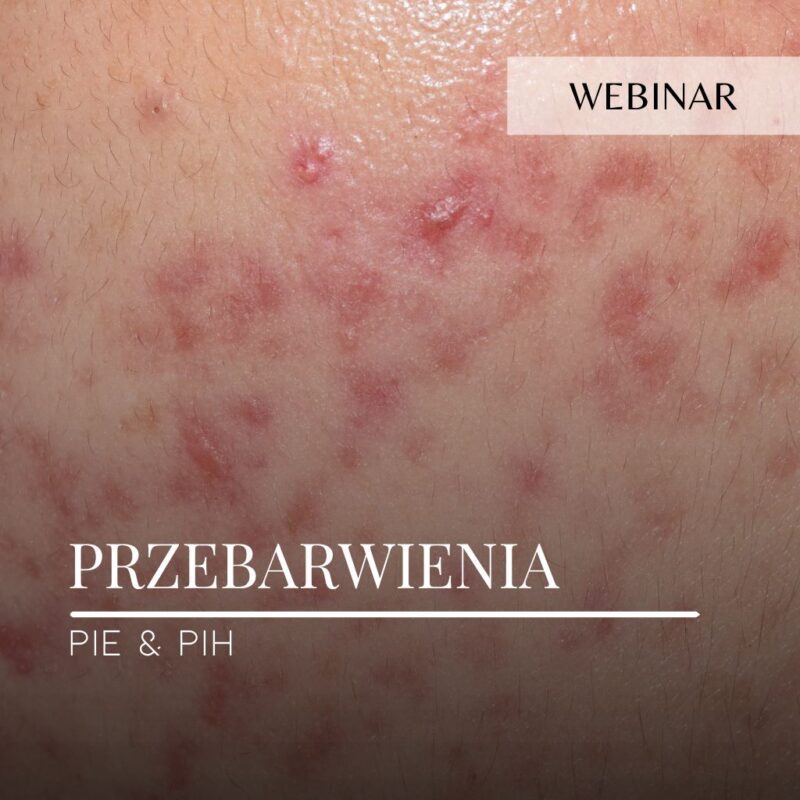 Webinar_Przebarwienia PIE+PIH
