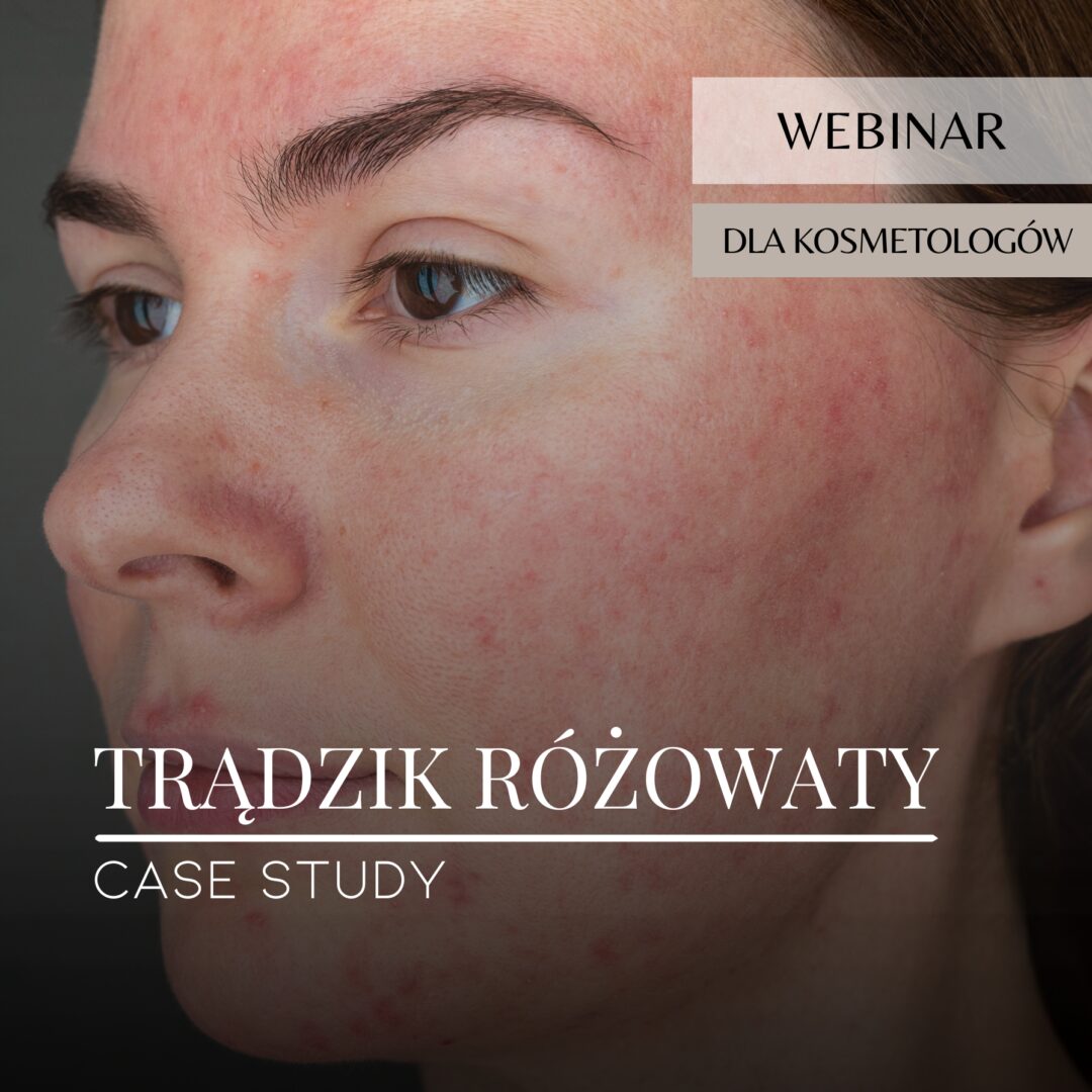 Webinar_Case study_Trądzik różowaty